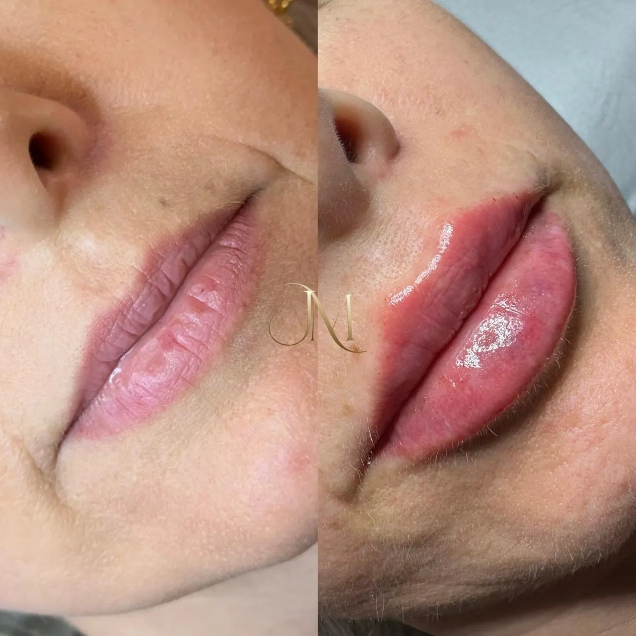Comparativo de lábios antes e depois do preenchimento labial