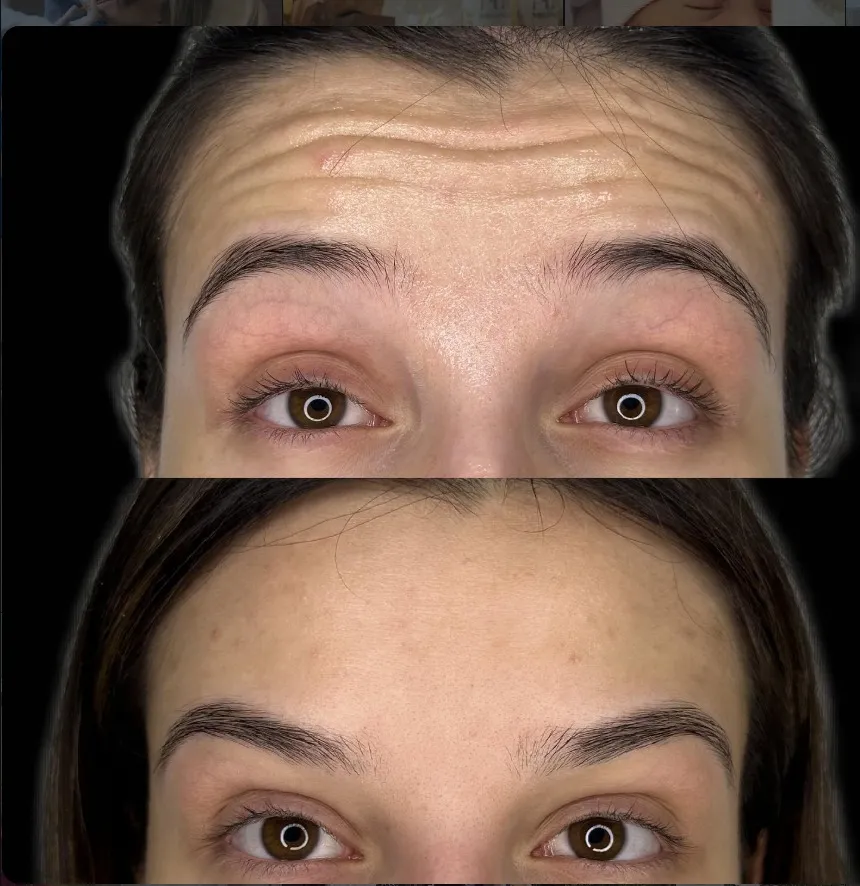 Comparativo da região da testa antes e depois da aplicação de toxina botulínica